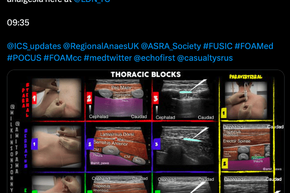 
London Trauma Conference 2024: Key Insights
Day 2 of the London Trauma Conference delivered impactful discussions on trauma care innovations, including advanced resuscitation strategies, rib fracture management, and prehospital interventions. Highlights featured Professor Karim Brohi's insights on cardiogenic shock, VA-ECMO, and cardiac output monitoring. Talks on blunt cerebrovascular injury, shaken baby syndrome, and interpersonal violence emphasized evolving trauma management approaches. Networking and expert panels underlined the event’s success. Don’t miss Oslo’s Prehospital Trauma Conference in 2025. #FOAMed #TraumaCare #EmergencyMedicine